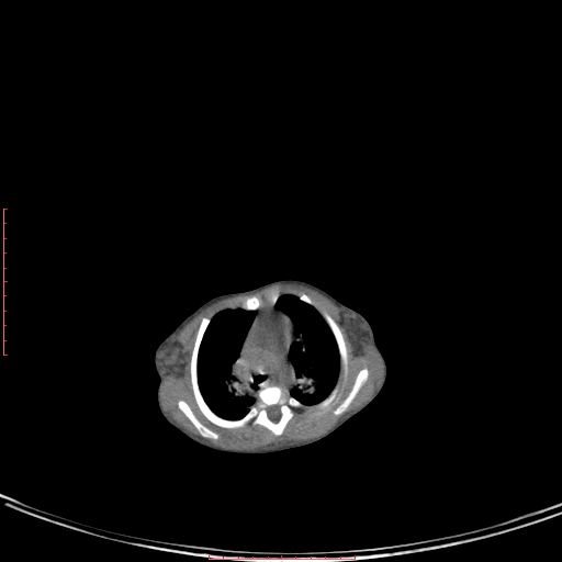 Autosomal recessive polycystic kidney disease associated with Caroli disease (Radiopaedia 61932-69984 B 36).jpg