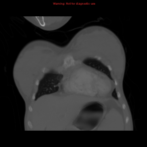 Avascular necrosis in sickle cell disease (Radiopaedia 17448-17152 Coronal bone window 22).jpg