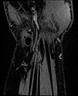 Avascular necrosis of the capitate (Radiopaedia 88317-104948 Coronal T1 vibe 78).jpg