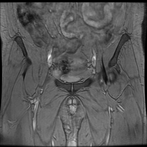 Avascular necrosis of the hip (Radiopaedia 61503-69465 F 16).jpg