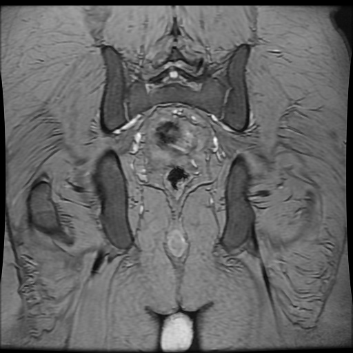 Avascular necrosis of the hip (Radiopaedia 61503-69465 F 80).jpg