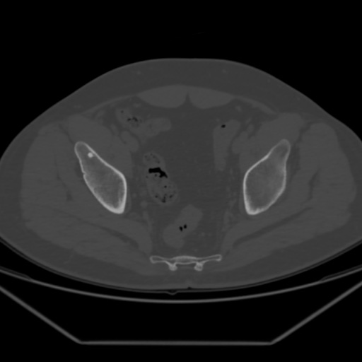 File:Avascular necrosis of the hip (Radiopaedia 61503-69467 Axial bone window 22).jpg