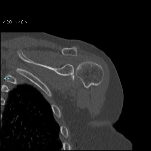 Avascular necrosis of the shoulder - Cruess stage I (Radiopaedia 77674-89887 Coronal bone window 39).jpg