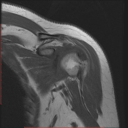 File:Avulsion fracture - greater tuberosity of humerus (Radiopaedia 25457-25703 Coronal T1 4).jpg