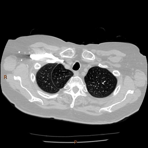 Azygos lobe (Radiopaedia 40161-42821 Axial lung window 4).jpg