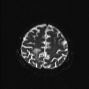 Balo concentric sclerosis (Radiopaedia 50458-55940 Axial DWI 5).jpg