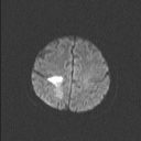 File:Balo concentric sclerosis (Radiopaedia 50458-55940 Axial DWI 52).jpg