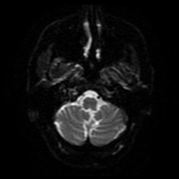 File:Balo concentric sclerosis (Radiopaedia 53875-59982 Axial DWI 28).jpg