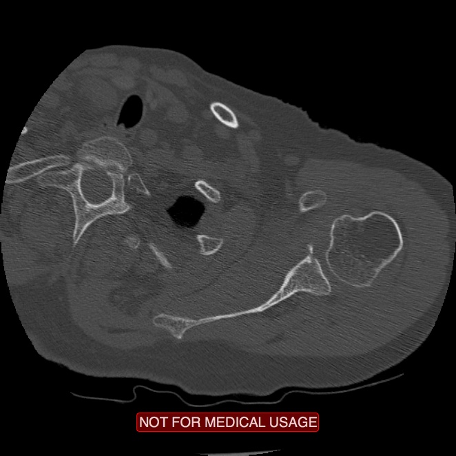 Bankart lesion (Radiopaedia 41497-44401 Axial bone window 55).jpg