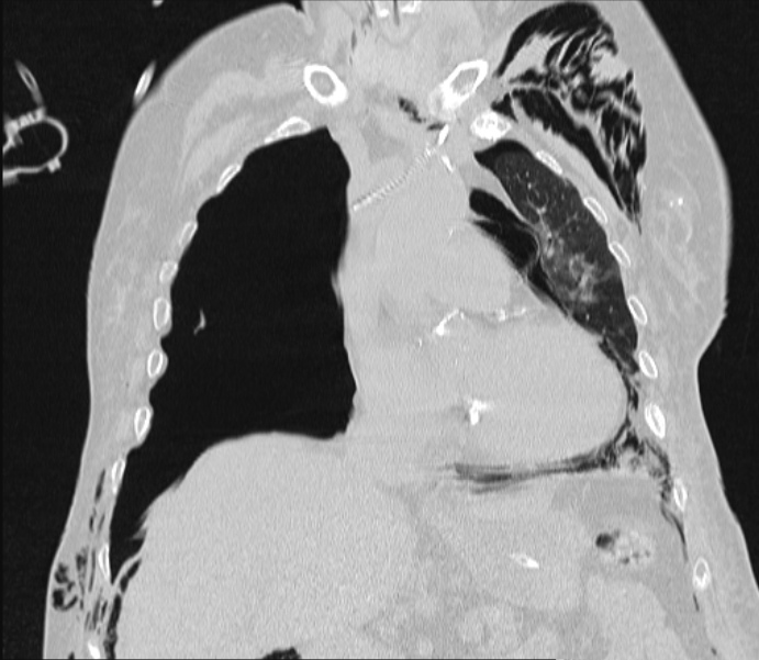 Barotrauma due to mechanical ventilation (Radiopaedia 28079-28336 Coronal lung window 42).jpg