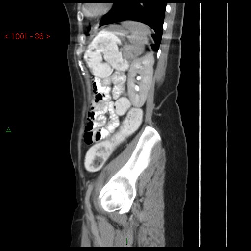 File:Bartholin gland cyst (Radiopaedia 54904-61181 Sagittal C+ delayed 36).jpg