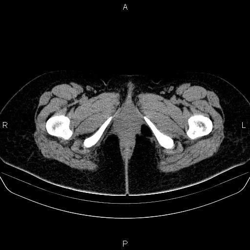 File:Bartholin gland cyst (Radiopaedia 62635-70930 Axial non-contrast 95).jpg