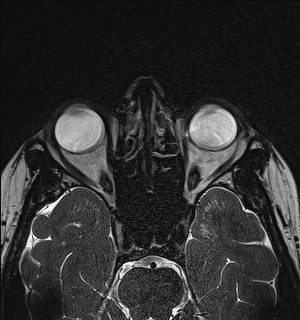 File:Basal cell carcinoma - nasal region (Radiopaedia 70292-80365 Axial Gradient Echo 71).jpg