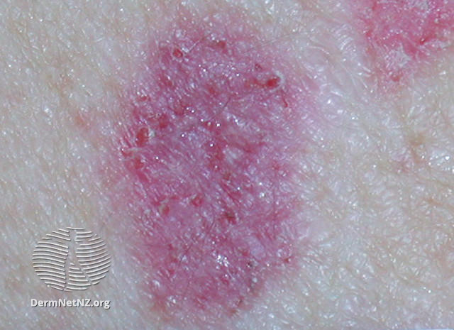 File:Basal cell carcinoma affecting the arms and legs 9 macro (DermNet NZ bcc-9-macro).jpg