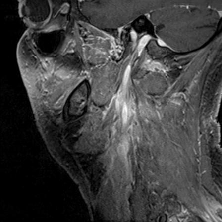 Base of tongue squamous cell carcinoma (Radiopaedia 31174-31884 F 46).jpg