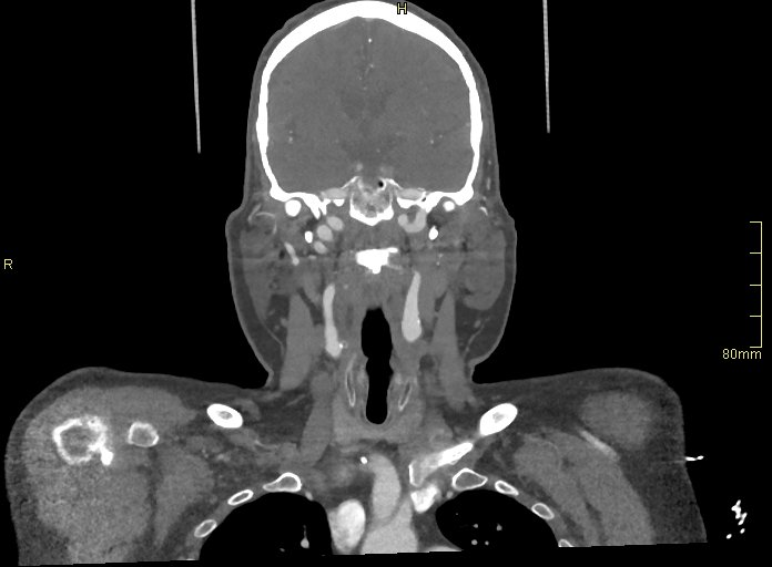 Basilar artery aneurysm (Radiopaedia 56261-62932 B 18).jpg