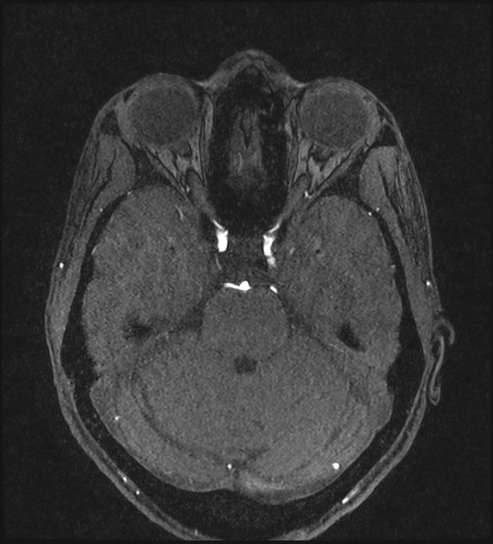 Basilar artery perforator aneurysm (Radiopaedia 82455-97733 Axial MRA 87).jpg