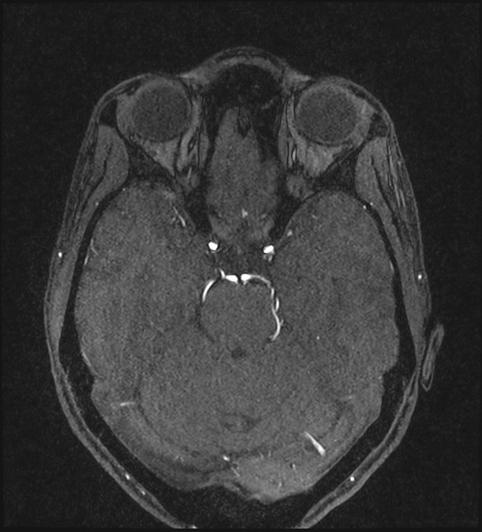 Basilar artery perforator aneurysm (Radiopaedia 82455-97733 Axial MRA 93).jpg