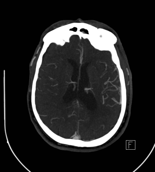 Basilar artery thrombosis (Radiopaedia 26986-27163 A 54).jpg