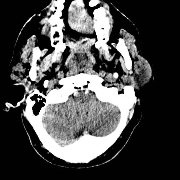 Basilar artery thrombosis (Radiopaedia 53351-59333 Axial non-contrast 24).jpg