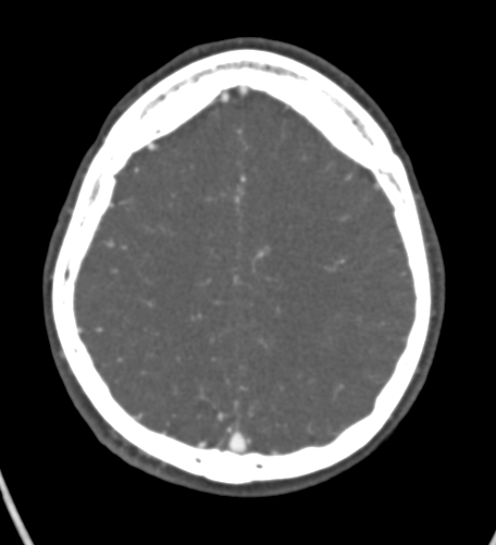 Basilar tip aneurysm with coiling (Radiopaedia 53912-60086 A 113).jpg