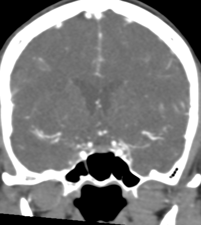 Basilar tip aneurysm with coiling (Radiopaedia 53912-60086 B 59).jpg