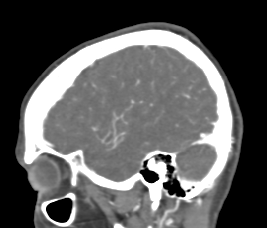 Basilar tip aneurysm with coiling (Radiopaedia 53912-60086 C 23).jpg