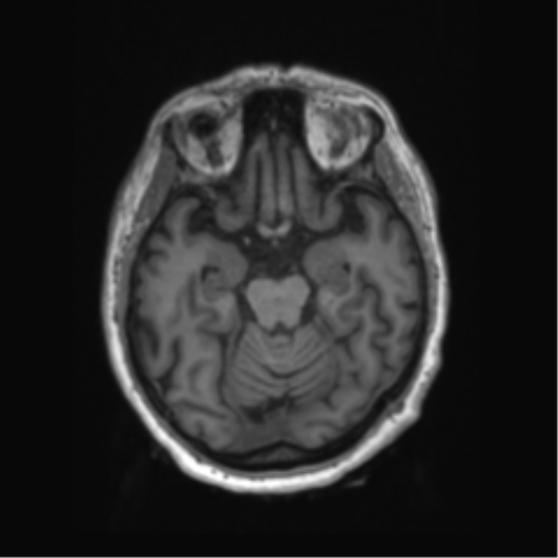 Behavioral variant frontotemporal dementia and late onset schizophrenia (Radiopaedia 52197-58083 Axial T1 69).png