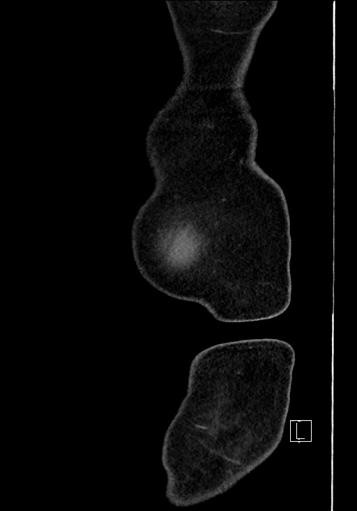 Benign colonic stricture with colo-colonic fistula (Radiopaedia 59439-66800 C 4).jpg