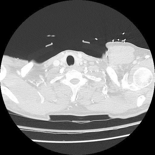 Benign post-traumatic pseudopneumoperitoneum (Radiopaedia 71199-81495 Axial lung window 10).jpg