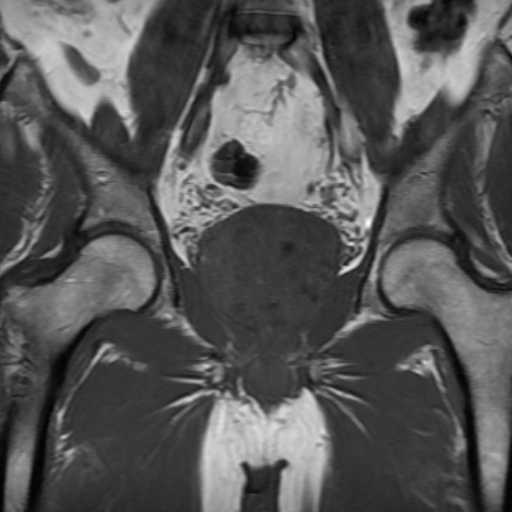 File:Benign prostatic nodular hyperplasia (Radiopaedia 16917-16634 Coronal T1 11).jpg