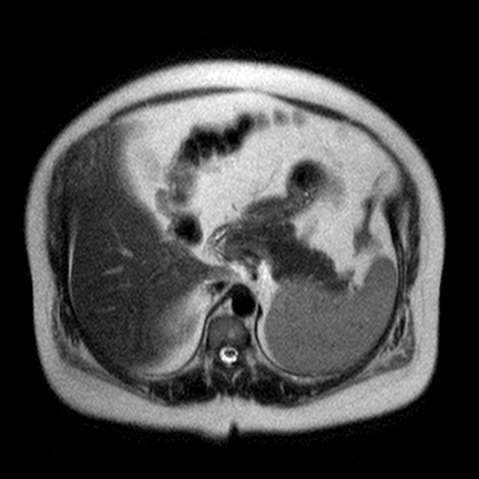File:Benign seromucinous cystadenoma of the ovary (Radiopaedia 71065-81300 Axial T2 14).jpg