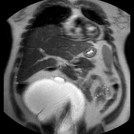 File:Benign seromucinous cystadenoma of the ovary (Radiopaedia 71065-81300 Coronal T2 18).jpg