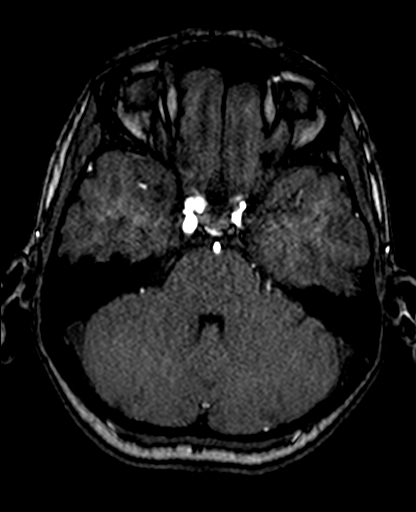 File:Berry aneurysm of the terminal internal carotid artery (Radiopaedia 88286-104918 Axial TOF 86).jpg