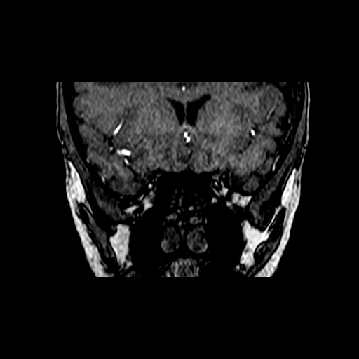 Berry aneurysm of the terminal internal carotid artery (Radiopaedia 88286-104918 Coronal TOF 22).jpg