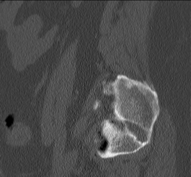 Bertolotti syndrome (Radiopaedia 24864-25128 Sagittal bone window 53).jpg