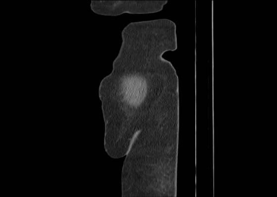Bicameral celiacomesenteric aneurysm (Radiopaedia 55766-62327 B 2).jpg