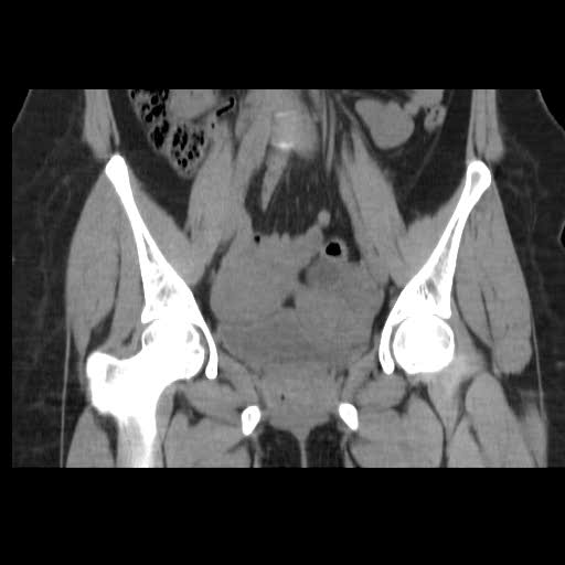 File:Bicornuate uterus- on MRI (Radiopaedia 49206-54296 Coronal non-contrast 9).jpg