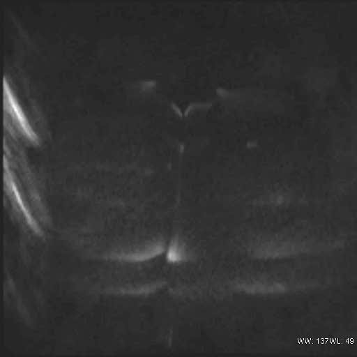 File:Bicornuate uterus (MRI) (Radiopaedia 49206-54297 Axial 121).jpg