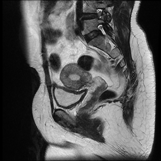 File:Bicornuate uterus (Radiopaedia 51676-57472 Sagittal T2 11).jpg