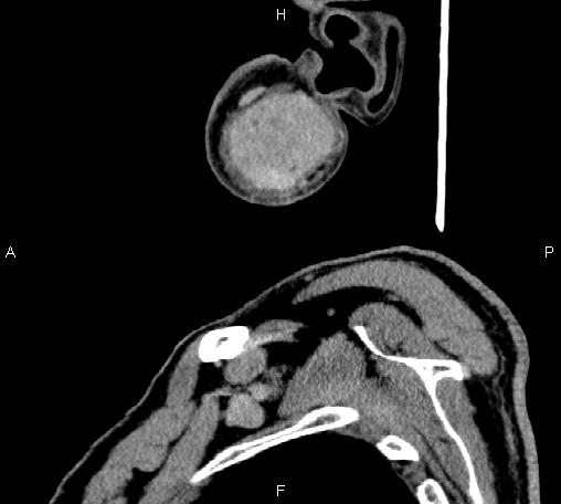 Bilateral Warthin tumors (Radiopaedia 84034-99263 D 71).jpg