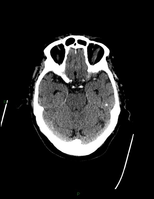 Bilateral acute middle cerebral artery territory infarcts (Radiopaedia 77319-89401 Axial non-contrast 29).jpg