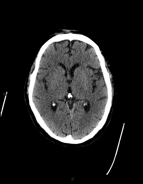 Bilateral acute middle cerebral artery territory infarcts (Radiopaedia 77319-89401 Axial non-contrast 42).jpg