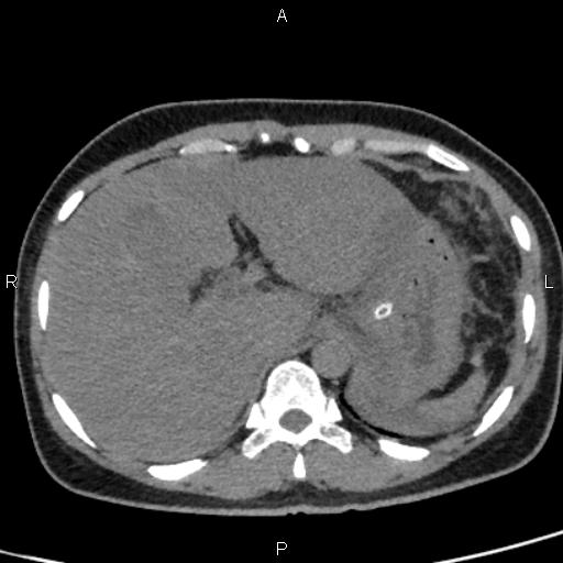 Bilateral adrenal gland hyperenhancement in pancreatitis (Radiopaedia 86642-102753 Axial non-contrast 19).jpg