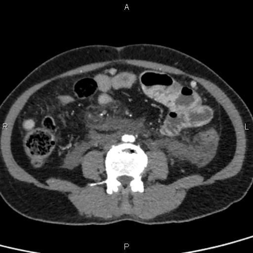 Bilateral adrenal gland hyperenhancement in pancreatitis (Radiopaedia 86642-102753 B 83).jpg