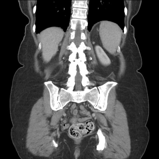 Bilateral adrenal granulocytic sarcomas (chloromas) (Radiopaedia 78375-91007 B 70).jpg