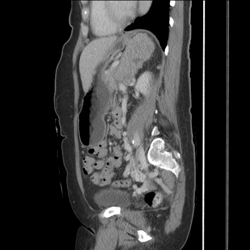 Bilateral adrenal granulocytic sarcomas (chloromas) (Radiopaedia 78375-91007 C 88).jpg