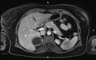 Bilateral adrenal myelolipoma (Radiopaedia 63058-71537 G 31).jpg