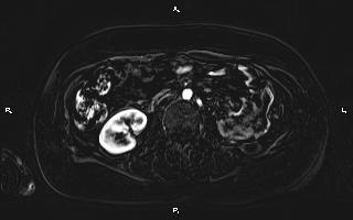 Bilateral adrenal myelolipoma (Radiopaedia 63058-71537 I 58).jpg
