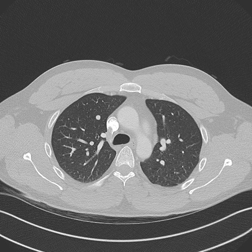 File:Bilateral atelectasis (Radiopaedia 48666-53675 Axial lung window 38).jpg